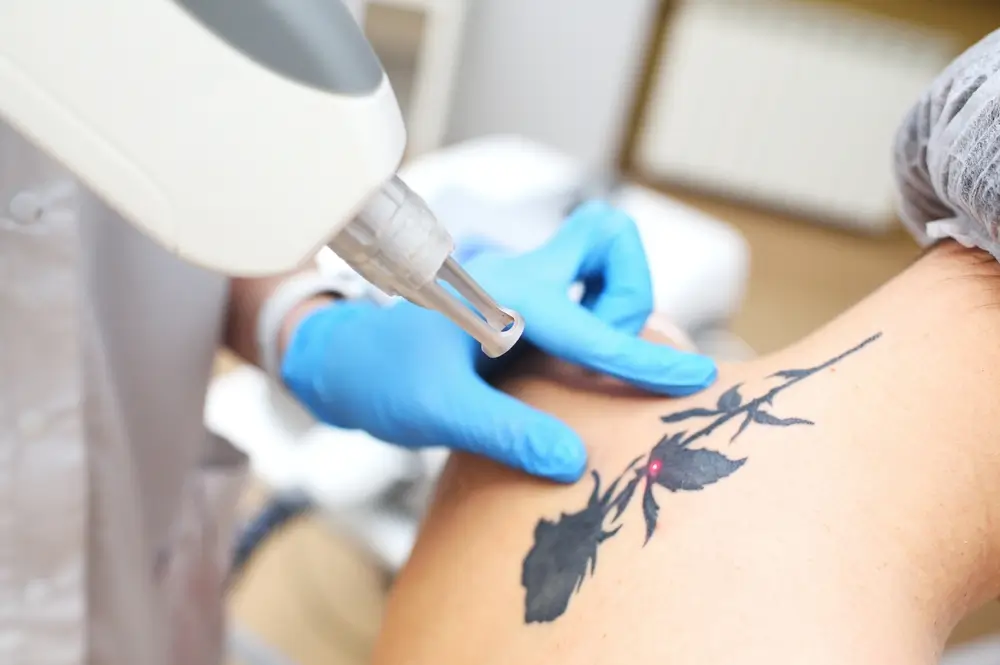 Eliminación de un tatuaje de flor negra usando un equipo láser profesional en una sesión de clínica estética.